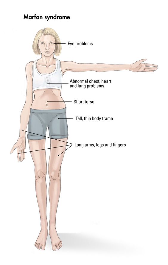 Marfan Syndrome: Causes, Symptoms, Diagnosis and Treatments